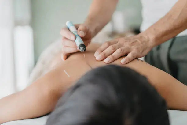 Acupuncture Session